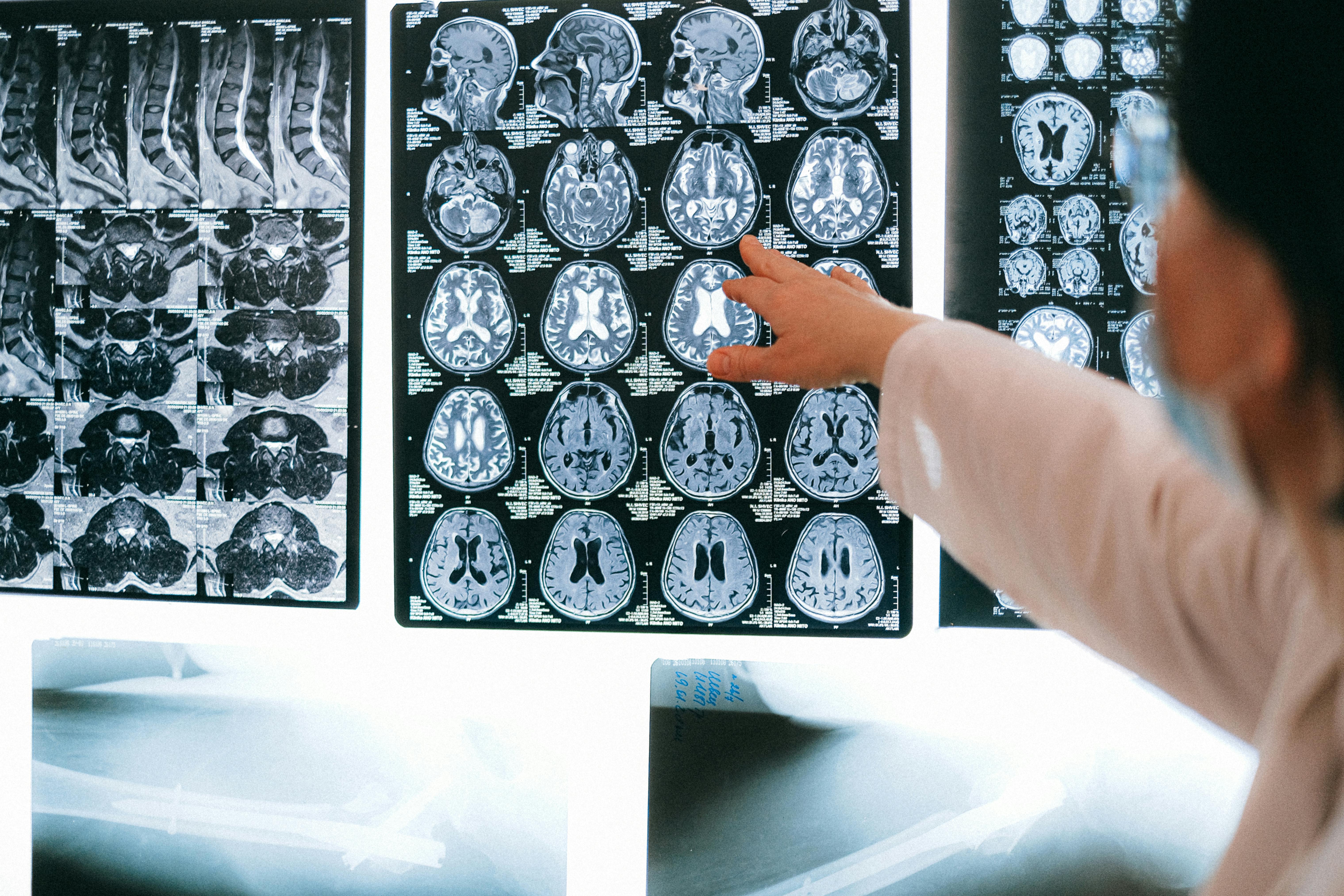Top Signs You Need an Autism Neurology Specialist in India